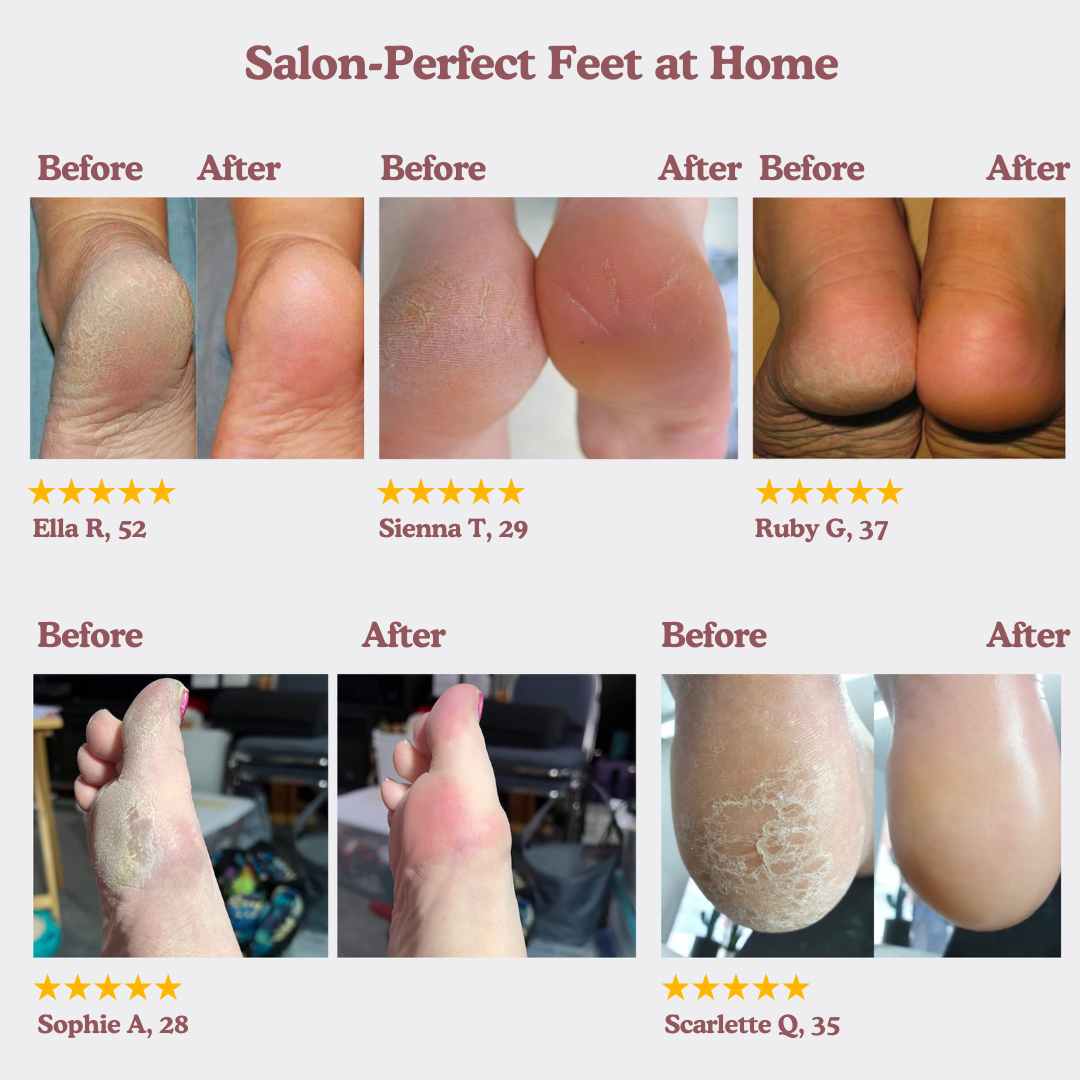 SoleMate Electric Foot Callus Remover