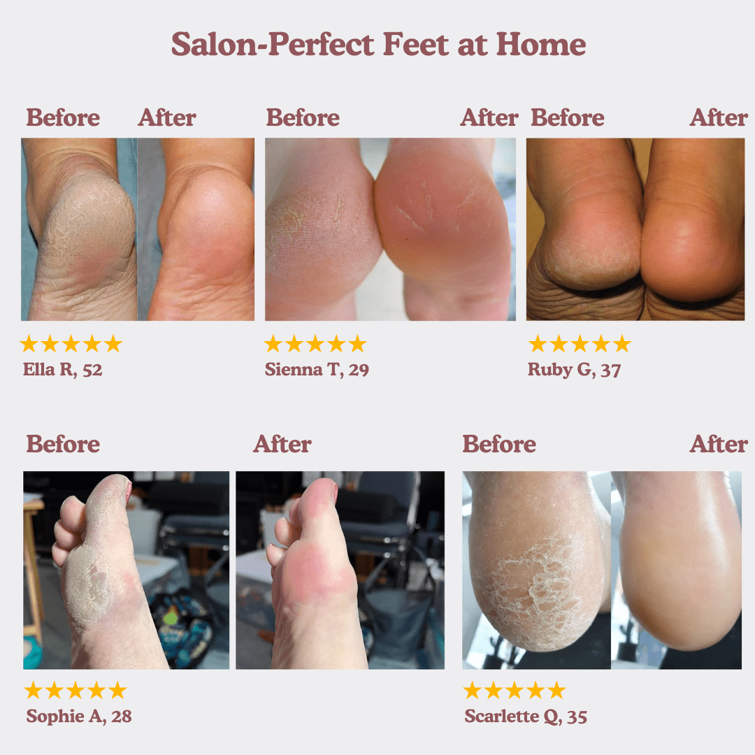 SoleMate Electric Foot Callus Remover - OneTapWireless